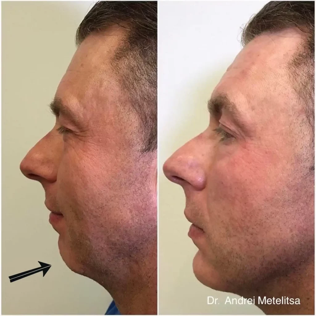 Chin And Jaw Augmentation Dermal Filler