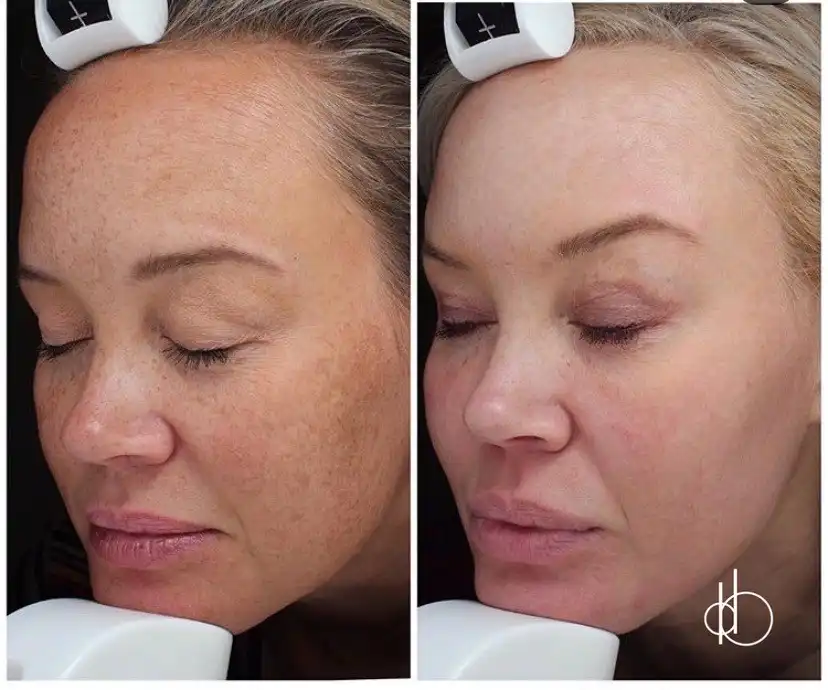 Fraxel Laser And Skincare