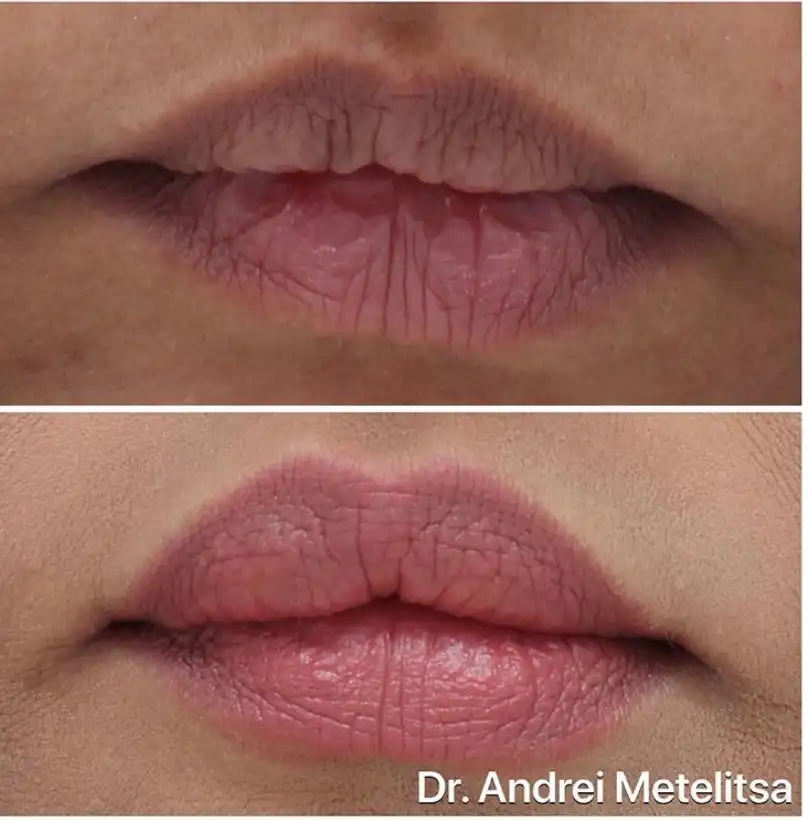 Lips Dermal Filler