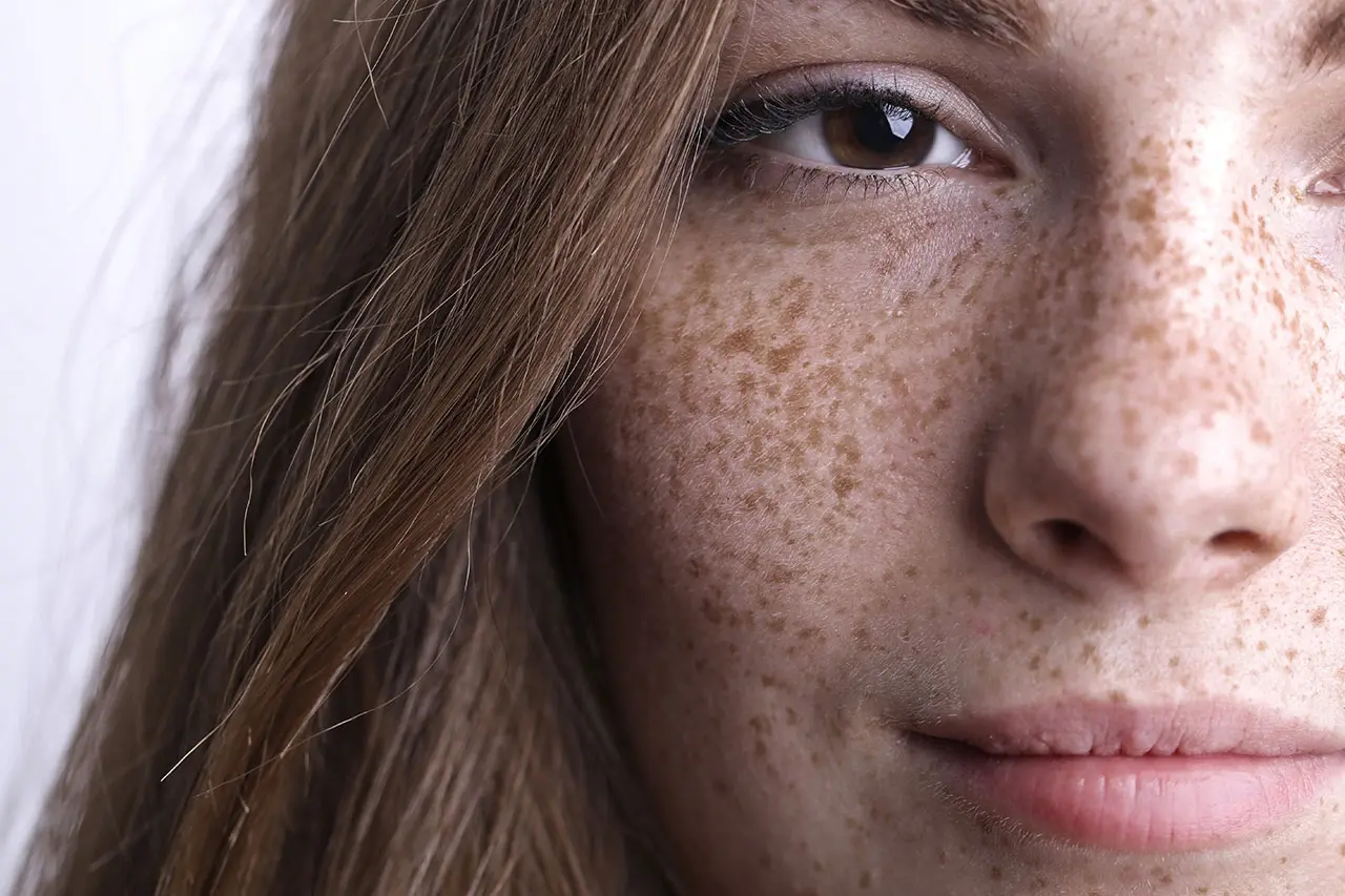 A close-up of a woman's face with visible freckles and sun spots concentrated on her cheek and nose area.