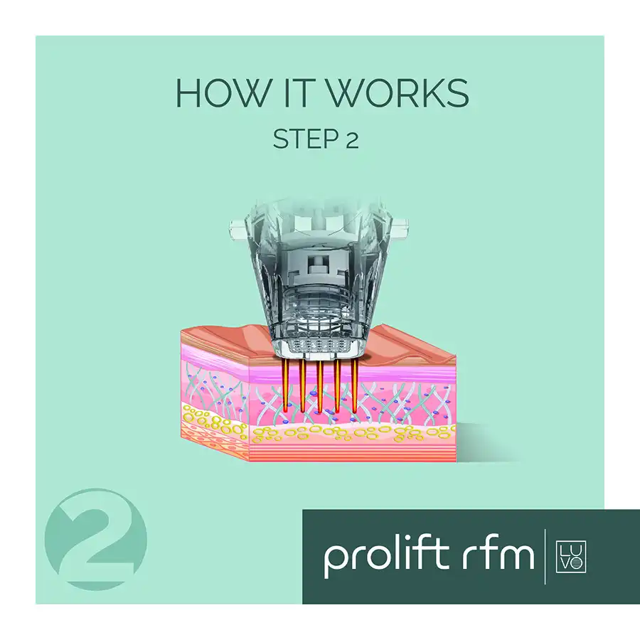 Prolift Rfm Step 2