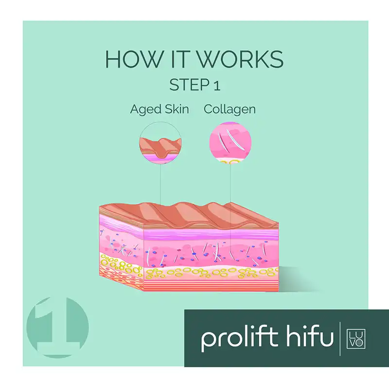Prolift Hifu Step 1