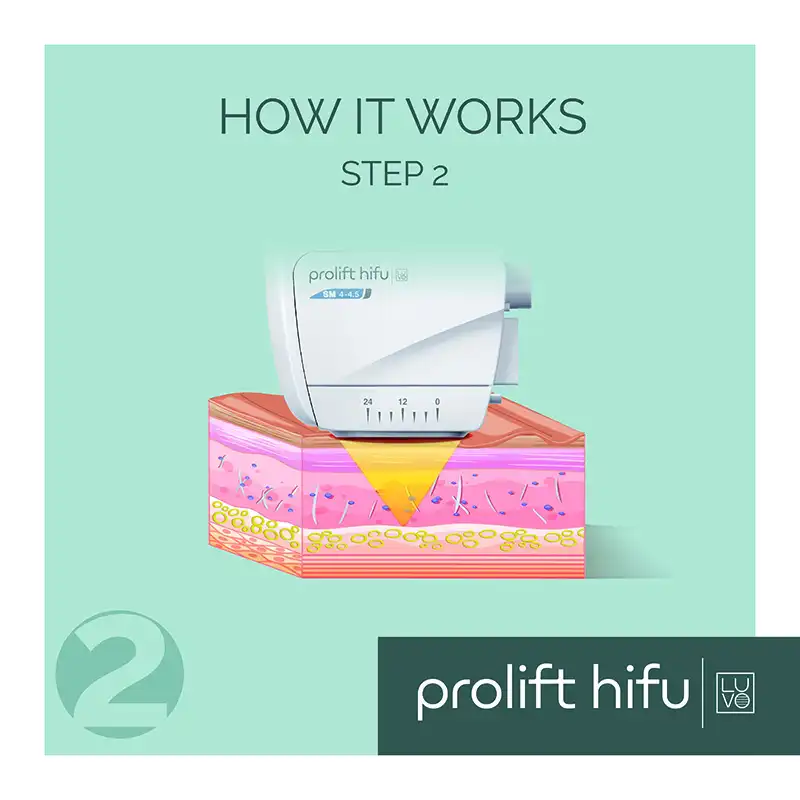 Prolift Hifu Step 2