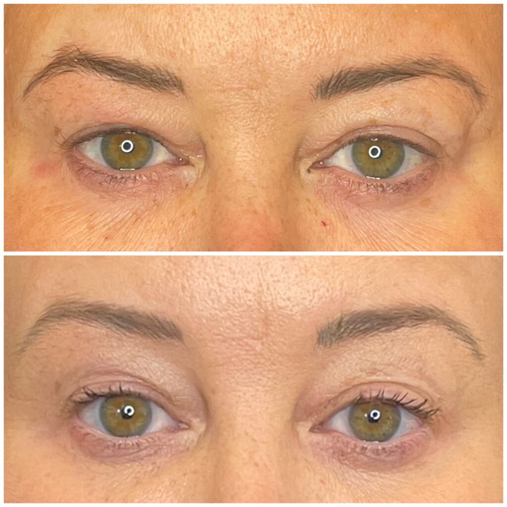 Before and after photos of a HIFU Skin Tightening treatment on the eye area