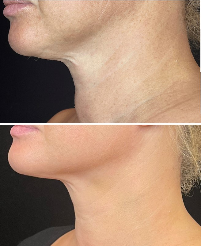 Before and after photos of a HIFU Skin Tightening treatment on the neck area