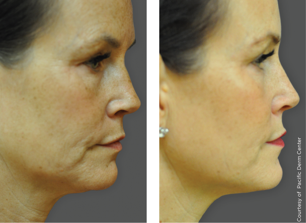 Before and after photos of Ultherapy treatment