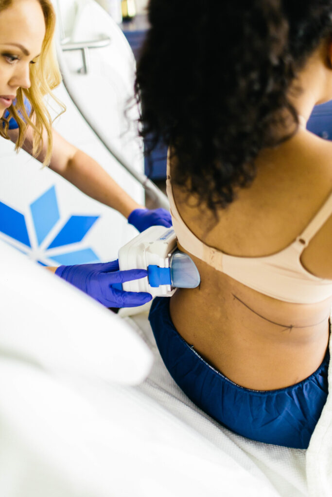 A woman receiving CoolSculpting treatment on her back