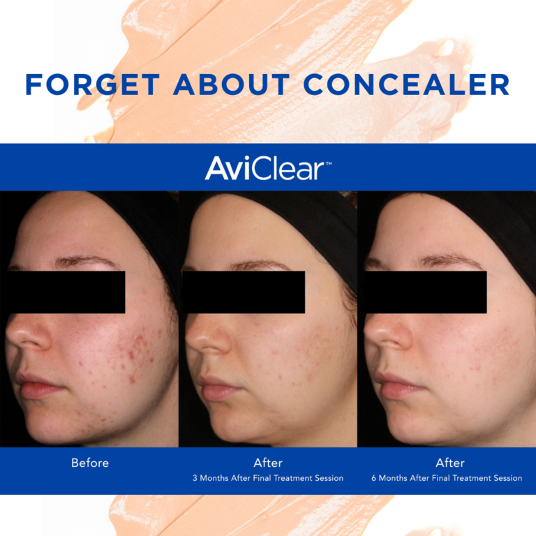 AviClear Acne Laser Treatment in Calgar Beacon Dermatology