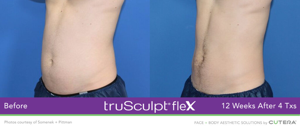 Before & After of trusculpt flex - What is truSculpt® ﬂex? 