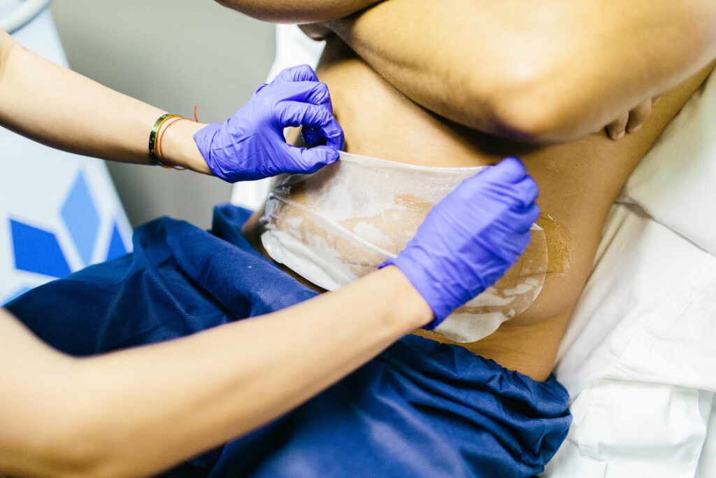 Coolsculpting being performed on man's stomach