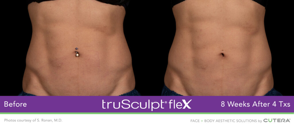 Before & After of trusculpt flex - What is truSculpt® ﬂex? 