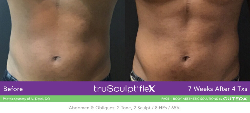 Before & After of trusculpt flex - What is truSculpt® ﬂex? 