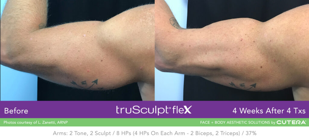 Before & After of trusculpt flex - What is truSculpt® ﬂex? 