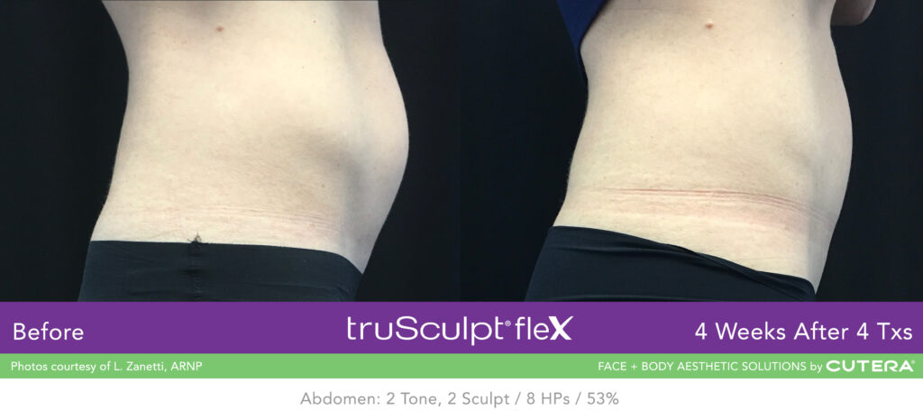 Before & After of trusculpt flex - What is truSculpt® ﬂex? 