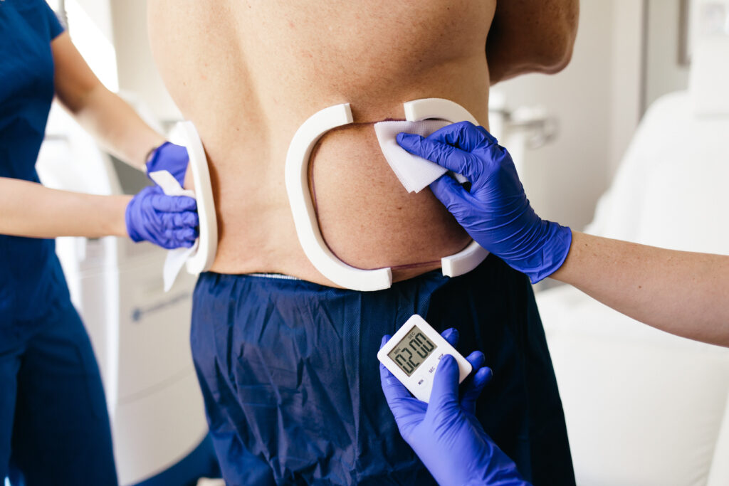 Coolsculpting treatment on back & love handles