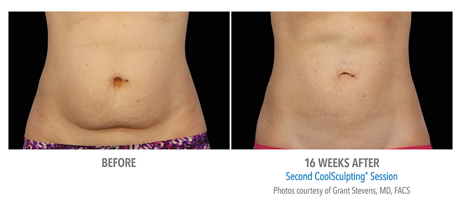 Before & After of CoolSculpting Treatment on abdomen 