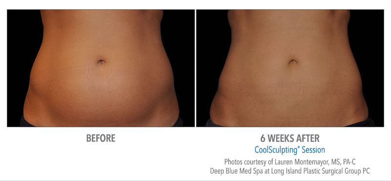 Before & After of CoolSculpting Treatment on abdomen 