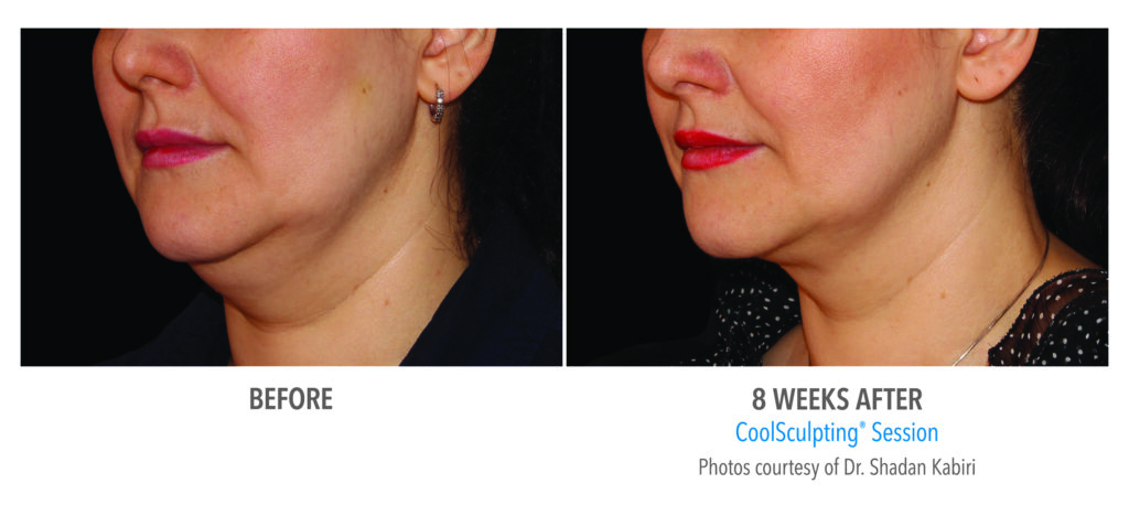 Before & After of CoolSculpting Treatment on chin & neck 