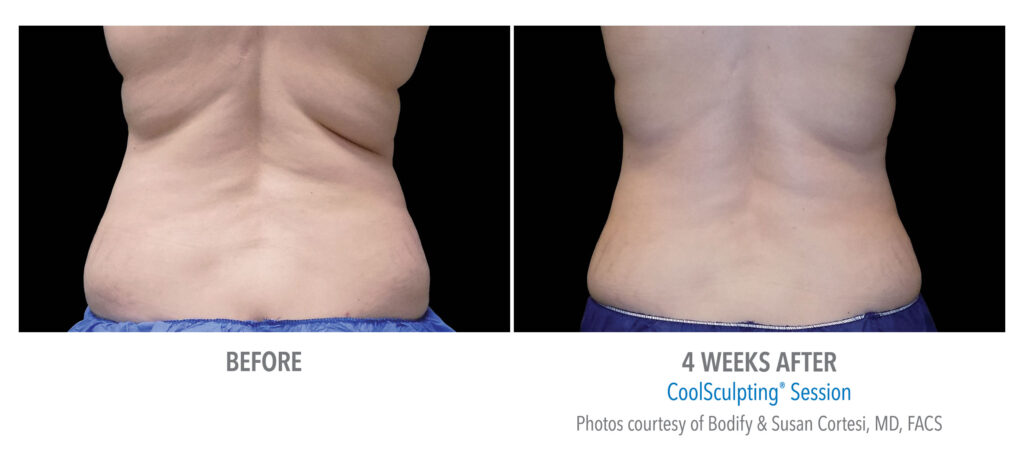 How Many CoolSculpting® Treatments Are Needed For Stomach