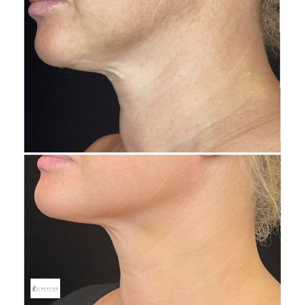 ultherapy before and after at beacon