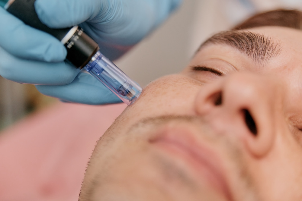 A close-up of a man receiving a microneedling treatment.