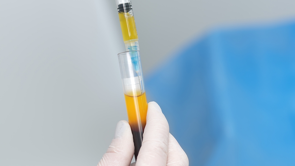 A gloved hand holds a syringe filled with platelet-rich plasma (PRP) extracted from a test tube during a medical procedure.