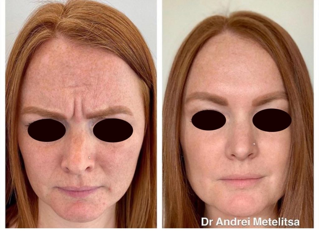 Botox before and after treatment showing reduced forehead lines and smoother skin appearance.